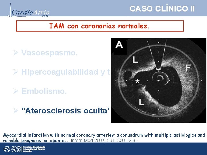 CASO CLÍNICO II IAM con coronarias normales. Ø Vasoespasmo. Ø Hipercoagulabilidad y trombosis. Ø