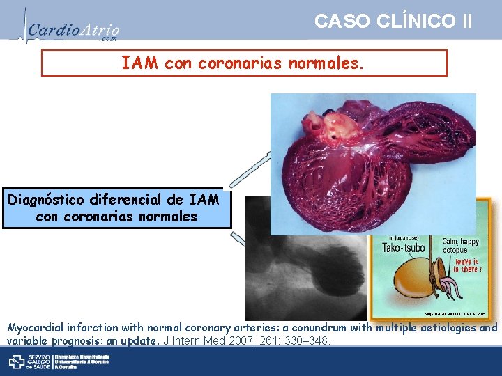 CASO CLÍNICO II IAM con coronarias normales. Sd. Tako-tsubo Diagnóstico diferencial de IAM con