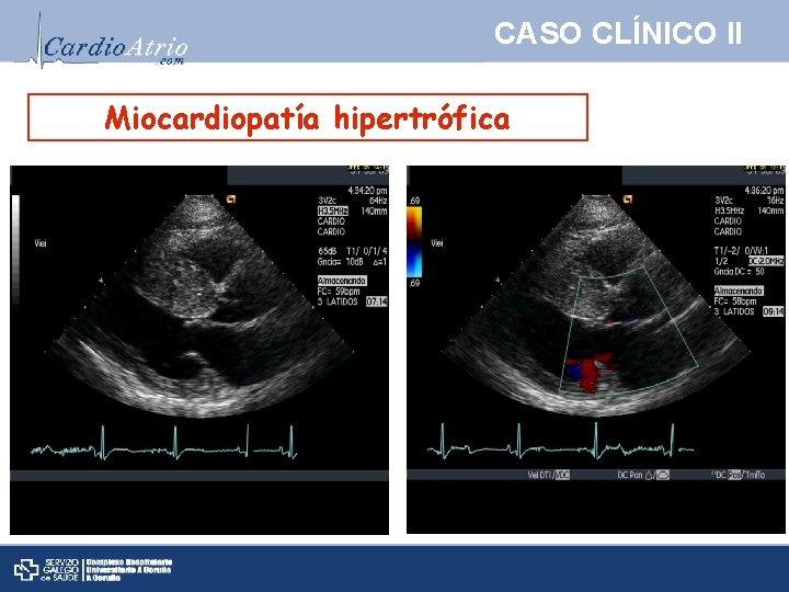 CASO CLÍNICO II Miocardiopatía hipertrófica 