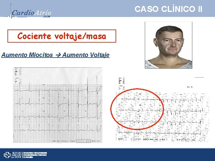 CASO CLÍNICO II Cociente voltaje/masa Aumento Miocitos Aumento Voltaje 