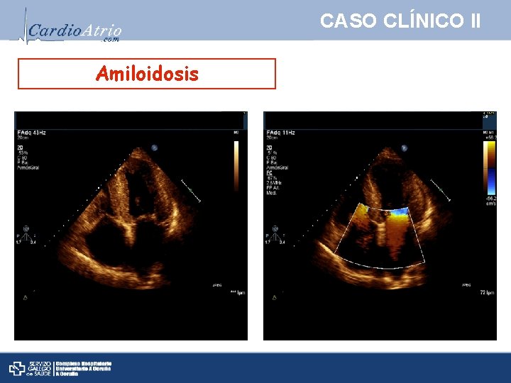 CASO CLÍNICO II Amiloidosis 