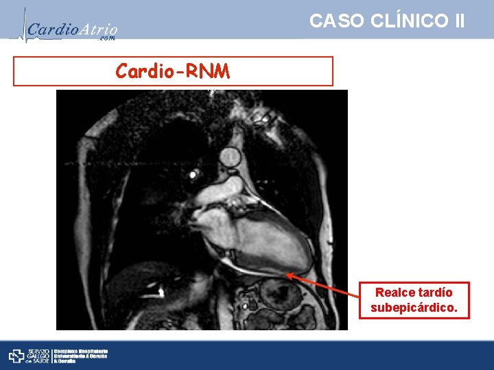 CASO CLÍNICO II Cardio-RNM Realce tardío subepicárdico. 