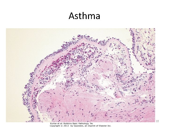 Asthma 22 