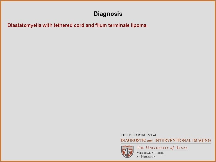 Diagnosis Diastatomyelia with tethered cord and filum terminale lipoma. 