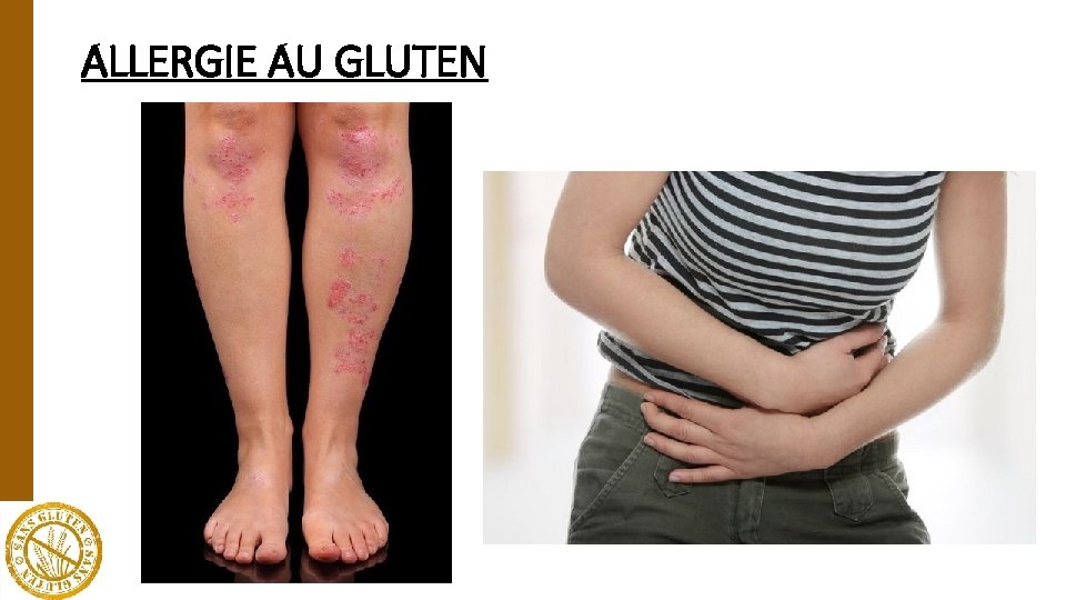 ALLERGIE AU GLUTEN 