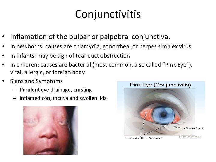 Conjunctivitis • Inflamation of the bulbar or palpebral conjunctiva. • In newborns: causes are