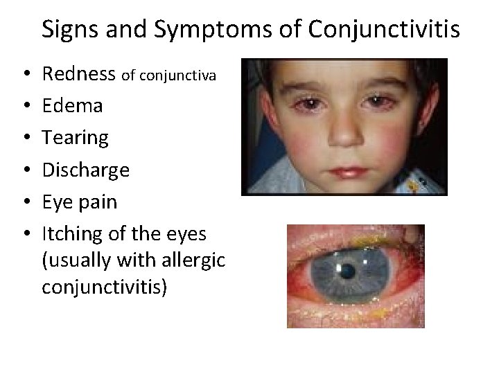 Signs and Symptoms of Conjunctivitis • • • Redness of conjunctiva Edema Tearing Discharge