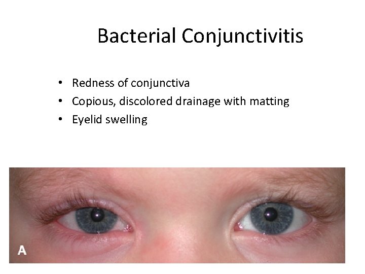 Bacterial Conjunctivitis • Redness of conjunctiva • Copious, discolored drainage with matting • Eyelid
