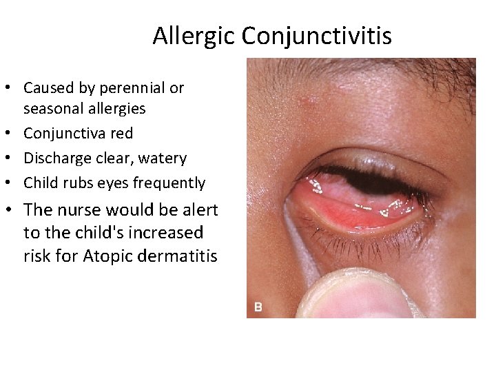 Allergic Conjunctivitis • Caused by perennial or seasonal allergies • Conjunctiva red • Discharge