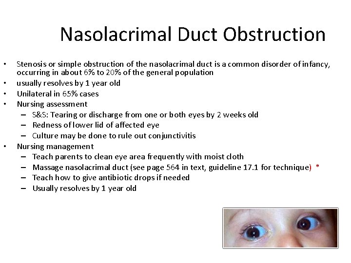 Nasolacrimal Duct Obstruction • • • Stenosis or simple obstruction of the nasolacrimal duct