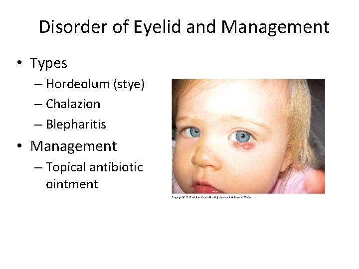 Disorder of Eyelid and Management • Types – Hordeolum (stye) – Chalazion – Blepharitis
