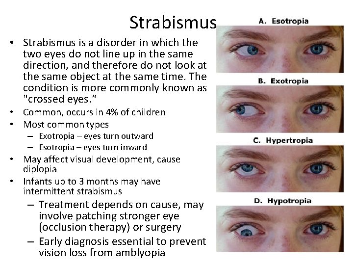 Strabismus • Strabismus is a disorder in which the two eyes do not line Strabismus • Strabismus is a disorder in which the two eyes do not line