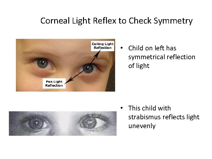 Corneal Light Reflex to Check Symmetry • Child on left has symmetrical reflection of