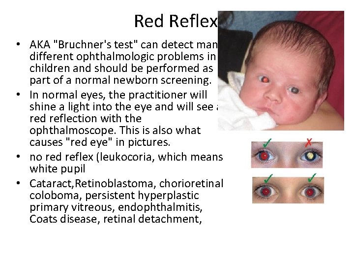 Red Reflex • AKA "Bruchner's test" can detect many different ophthalmologic problems in children