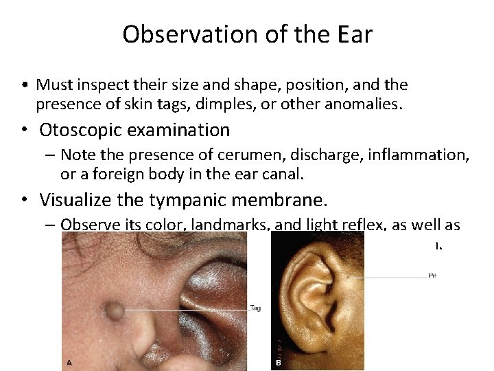 Observation of the Ear • Must inspect their size and shape, position, and the