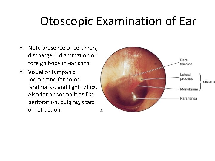 Otoscopic Examination of Ear • Note presence of cerumen, discharge, inflammation or foreign body