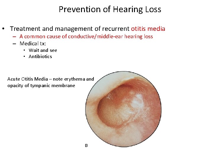 Prevention of Hearing Loss • Treatment and management of recurrent otitis media – A