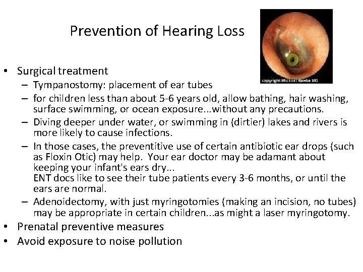 Prevention of Hearing Loss • Surgical treatment – Tympanostomy: placement of ear tubes –