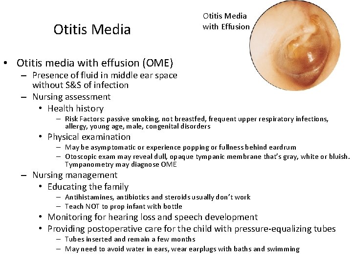 Otitis Media with Effusion • Otitis media with effusion (OME) – Presence of fluid