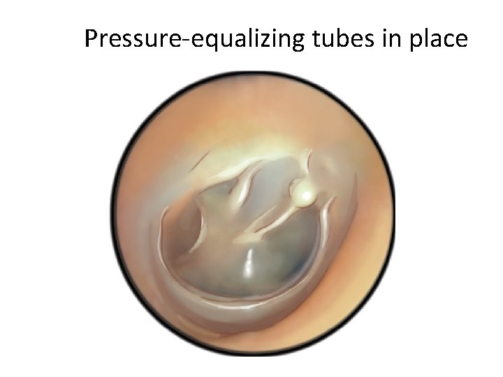 Pressure-equalizing tubes in place 