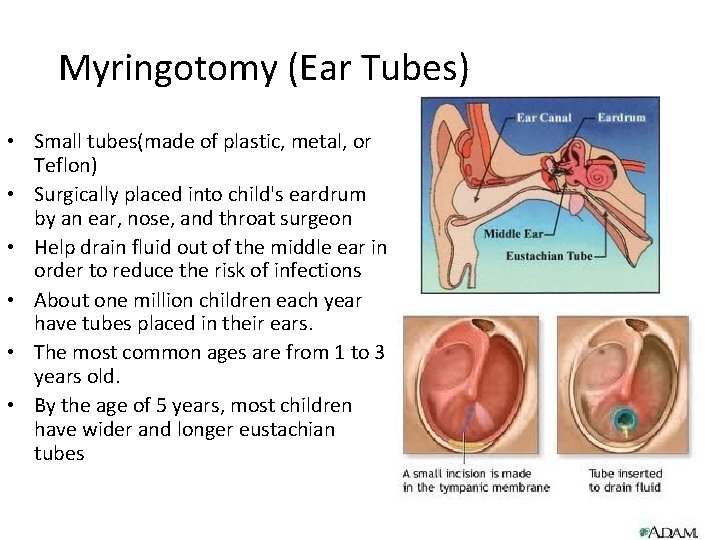 Myringotomy (Ear Tubes) • Small tubes(made of plastic, metal, or Teflon) • Surgically placed