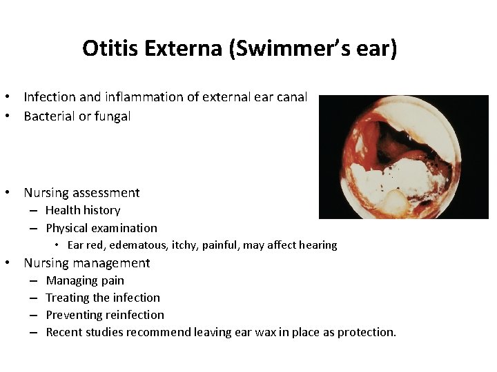 Otitis Externa (Swimmer’s ear) • Infection and inflammation of external ear canal • Bacterial