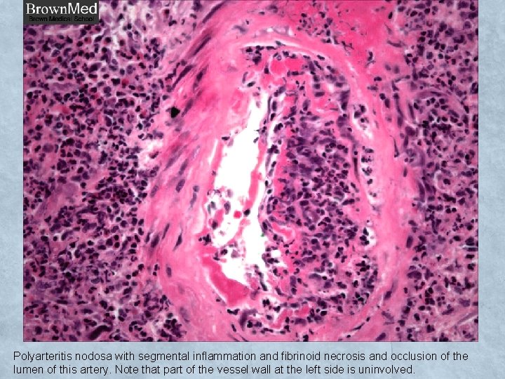 Polyarteritis nodosa with segmental inflammation and fibrinoid necrosis and occlusion of the lumen of