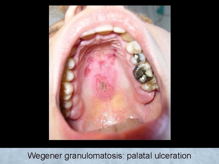Wegener granulomatosis: palatal ulceration 