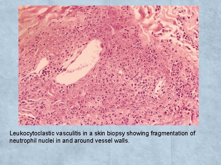 Leukocytoclastic vasculitis in a skin biopsy showing fragmentation of neutrophil nuclei in and around