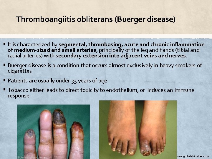 Thromboangiitis obliterans (Buerger disease) § It is characterized by segmental, thrombosing, acute and chronic