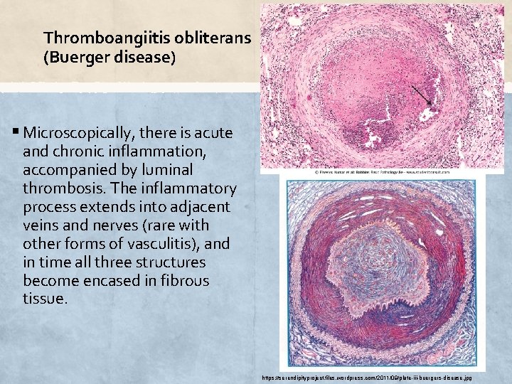 Thromboangiitis obliterans (Buerger disease) § Microscopically, there is acute and chronic inflammation, accompanied by