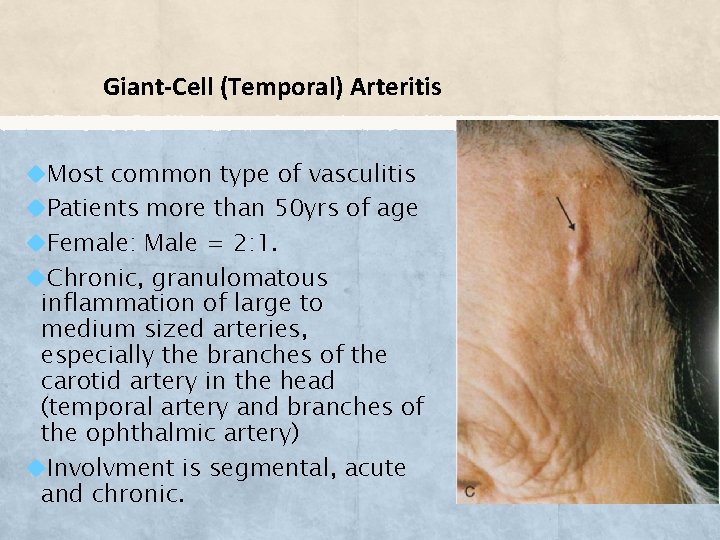Giant-Cell (Temporal) Arteritis Most common type of vasculitis Patients more than 50 yrs of
