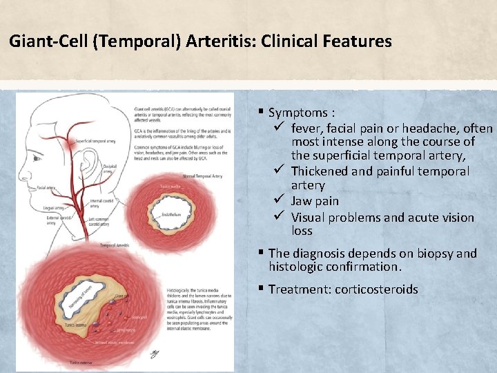 Giant-Cell (Temporal) Arteritis: Clinical Features § Symptoms : ü fever, facial pain or headache,