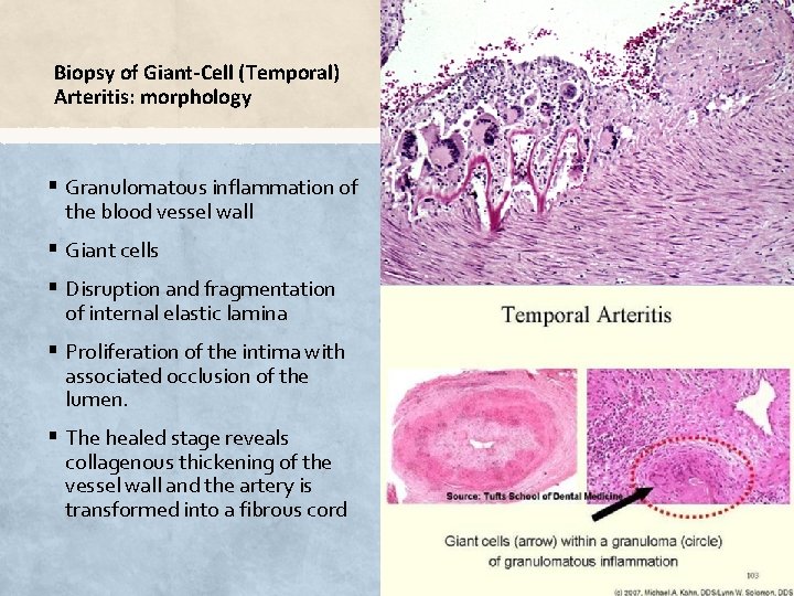 Biopsy of Giant-Cell (Temporal) Arteritis: morphology § Granulomatous inflammation of the blood vessel wall