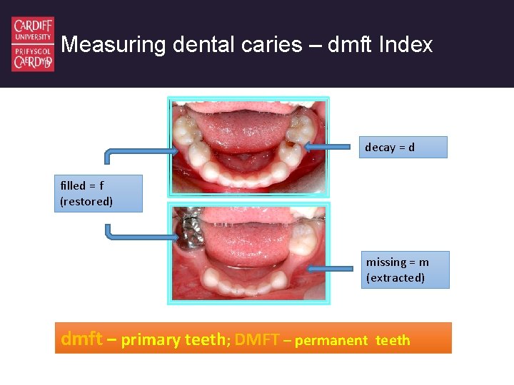 What proportion of caries into dentine at age