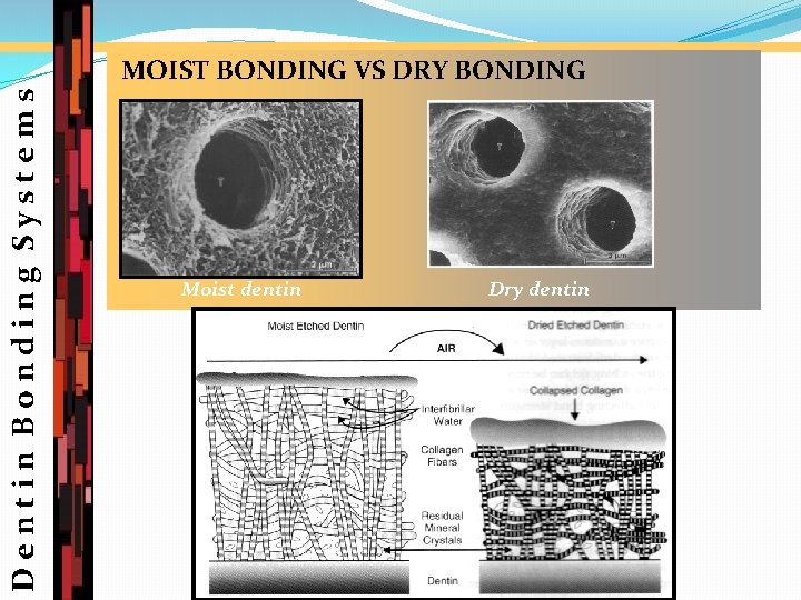 Dentin Bonding Systems MOIST BONDING VS DRY BONDING Moist dentin Dry dentin 