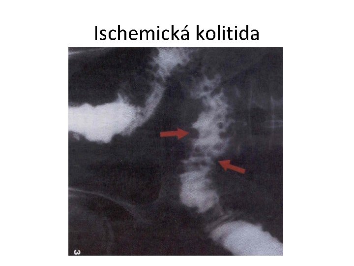 Ischemická kolitida 