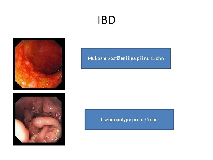IBD Mukózní postižení ilea při m. Crohn Pseudopolypy při m. Crohn 