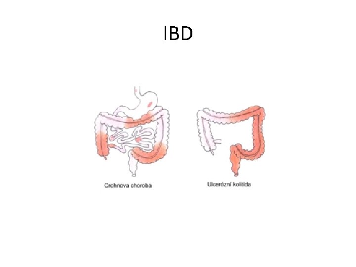IBD 