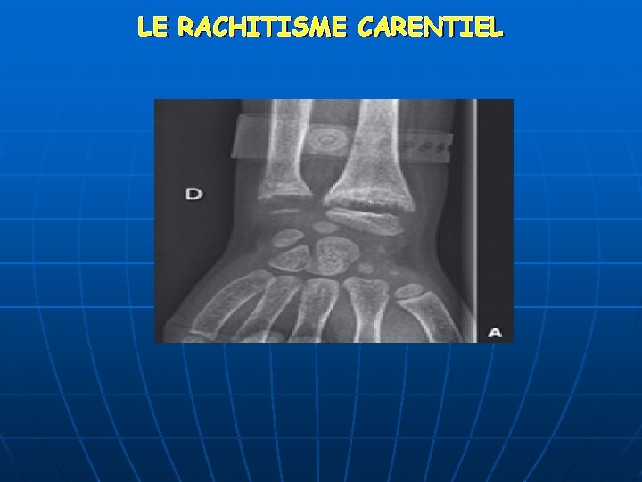 LE RACHITISME CARENTIEL 