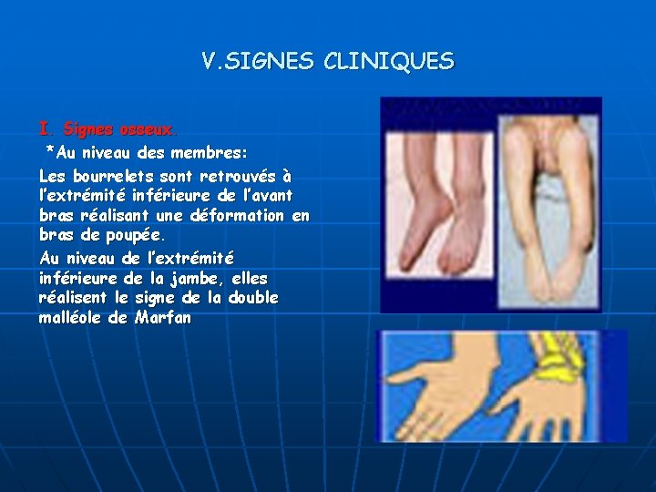 V. SIGNES CLINIQUES I. Signes osseux. *Au niveau des membres: Les bourrelets sont retrouvés