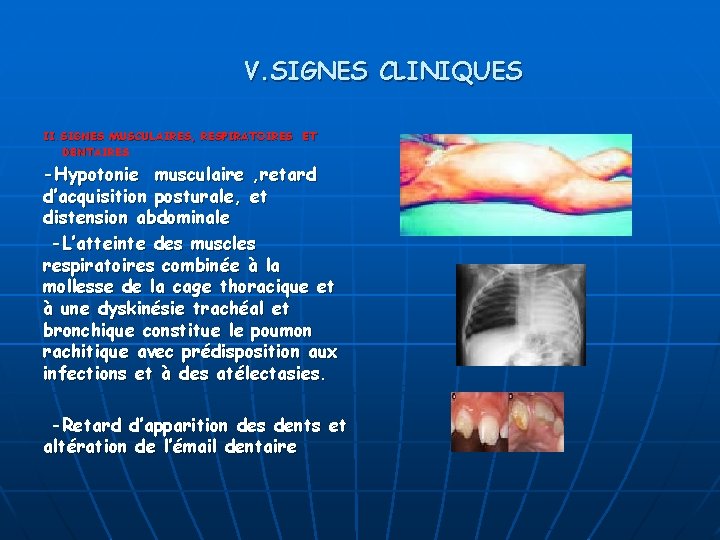 V. SIGNES CLINIQUES II. SIGNES MUSCULAIRES, RESPIRATOIRES ET DENTAIRES -Hypotonie musculaire , retard d’acquisition