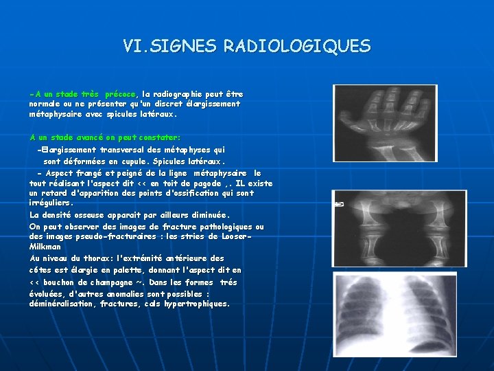 VI. SIGNES RADIOLOGIQUES -A un stade très précoce, la radiographie peut être normale ou