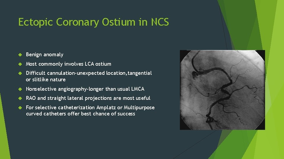 Ectopic Coronary Ostium in NCS Benign anomaly Most commonly involves LCA ostium Difficult cannulation-unexpected