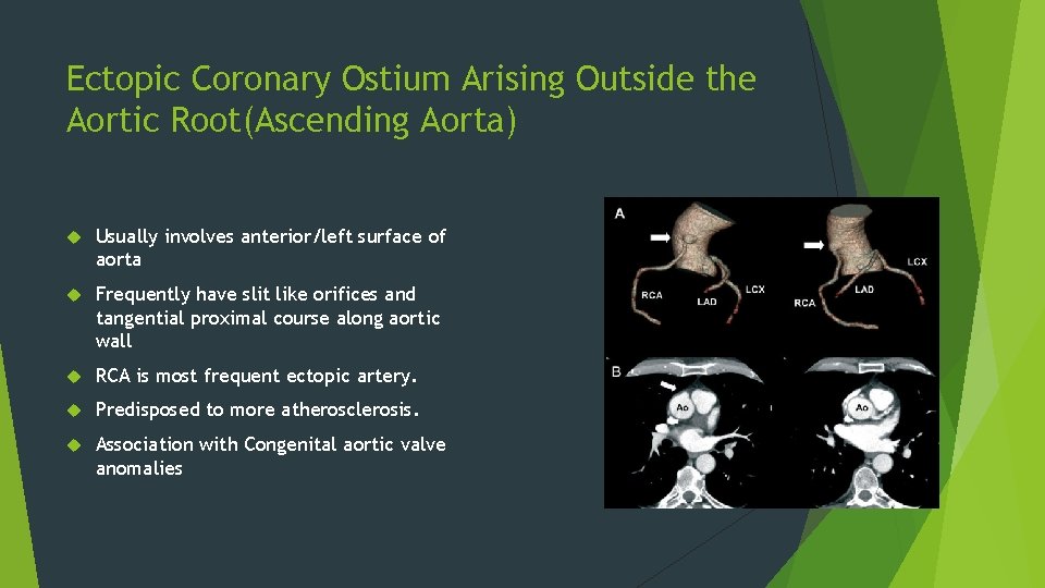 Ectopic Coronary Ostium Arising Outside the Aortic Root(Ascending Aorta) Usually involves anterior/left surface of