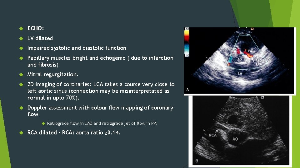  ECHO: LV dilated Impaired systolic and diastolic function Papillary muscles bright and echogenic