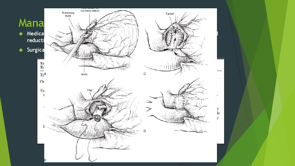 Management Medical supportive treatment: ventilation, inotropes, diuretics and afterload reduction. Surgical techniques: 