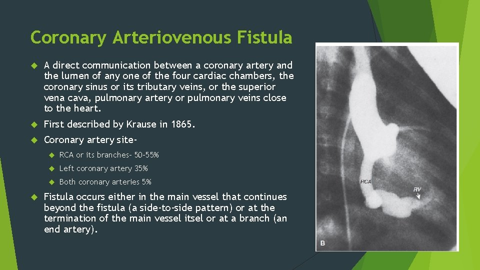 Coronary Arteriovenous Fistula A direct communication between a coronary artery and the lumen of