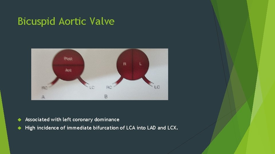 Bicuspid Aortic Valve Associated with left coronary dominance High incidence of immediate bifurcation of