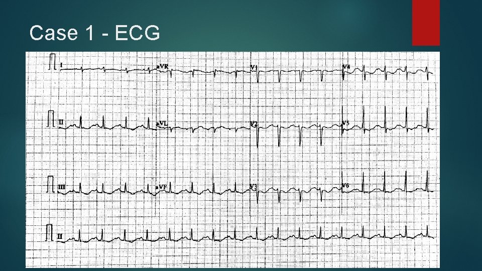 Case 1 - ECG 